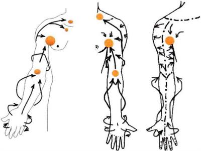 Study on the Design and Optimization of a Portable Monitoring and Auxiliary Treatment Device for Upper Extremity Lymphedema–Focus on the Rehabilitation Function of the Device